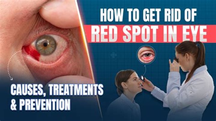 Understanding Harry Connick Jr.'s Bloodshot Eyes: A Deep Dive