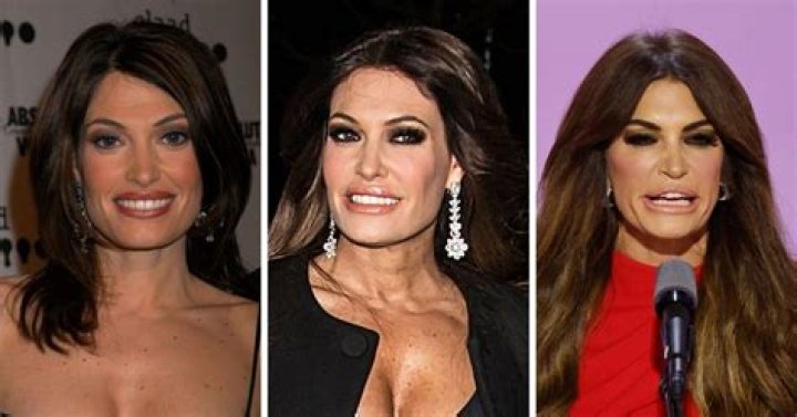 Unveiling The Allure: Kimberly Guilfoyle’s Botox Lips Journey